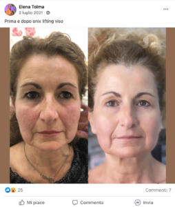 risultati estetiste con onix
